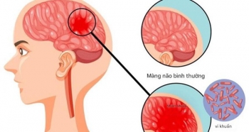 Bệnh não mô cầu có thể gây tử vong nhanh, chuyên gia cảnh báo những dấu hiệu nguy hiểm